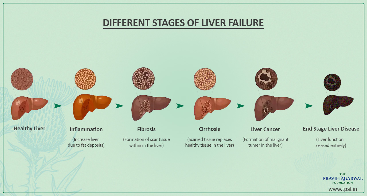 Figure From Chronic Liver Disease Staging Classification Based On | My ...