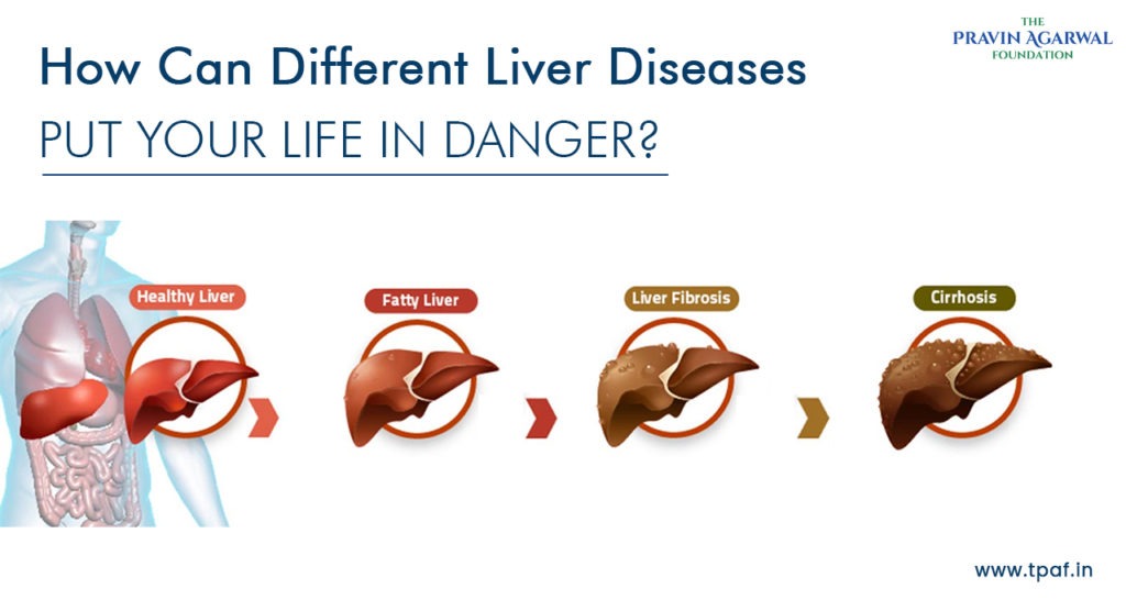 How Can Different Liver Diseases Put Your Life in Danger? TPAF